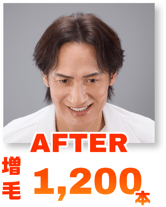 AFTER増毛1,200本